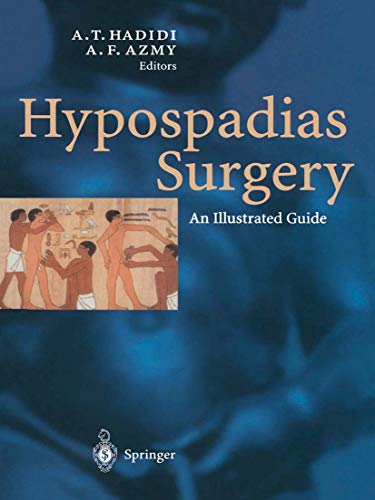 Hypospadias Surgery: An Illustrated Guide