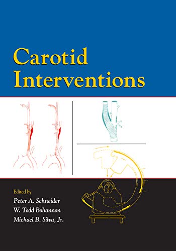 Carotid Interventions: 1st Edition