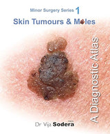 Skin Tumours & Moles: A Diagnostic Atlas (Minor Surgery Series)