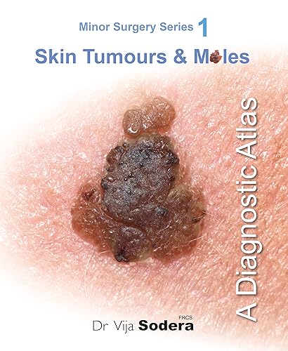 Skin Tumours & Moles: A Diagnostic Atlas (Minor Surgery Series)