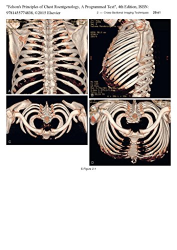 Felson's Principles of Chest Roentgenology, A Programmed Text: 4th Edition