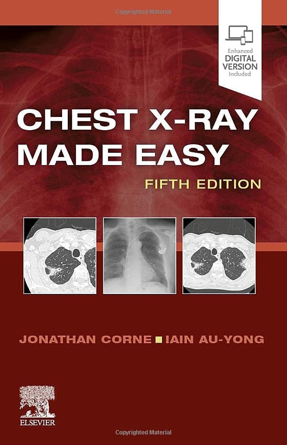 Chest X-Ray Made Easy: 5th Edition