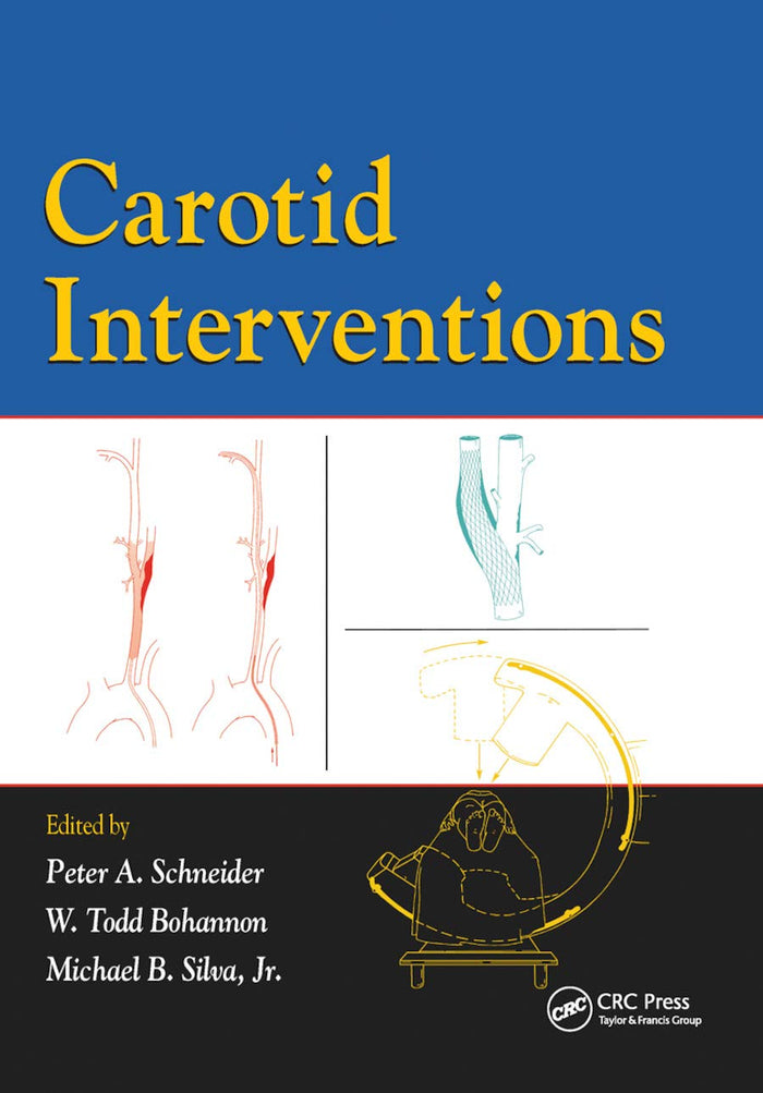 Carotid Interventions: 1st Edition