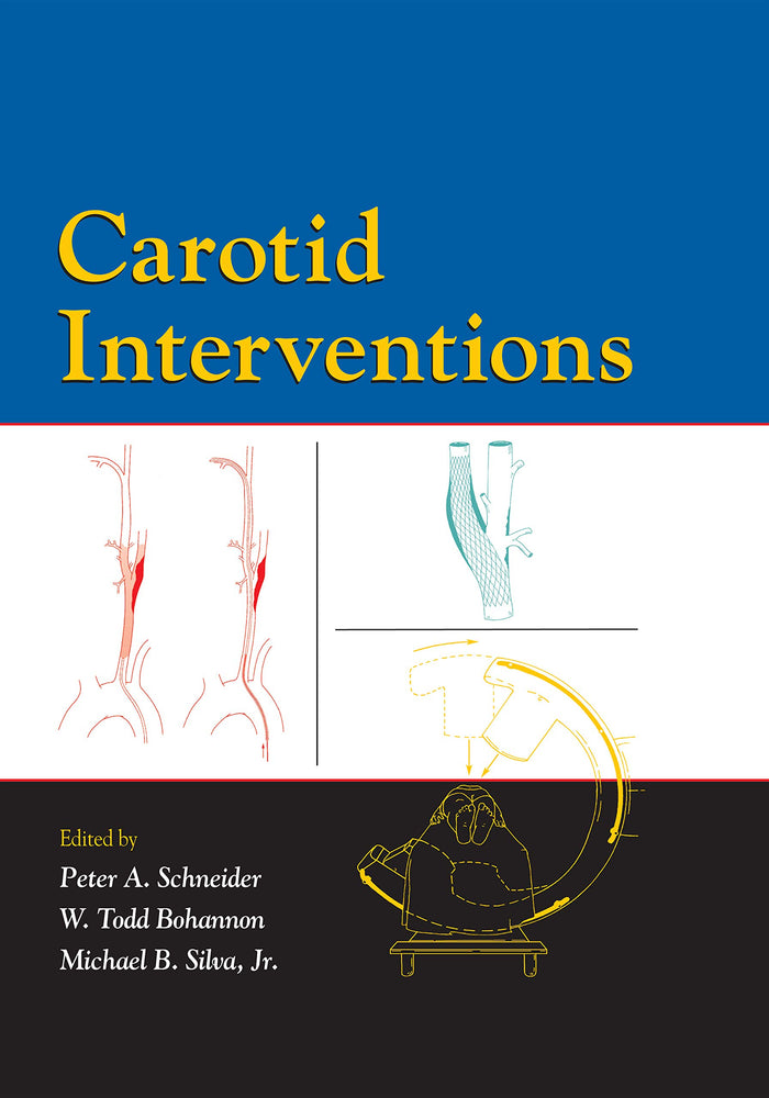 Carotid Interventions: 1st Edition