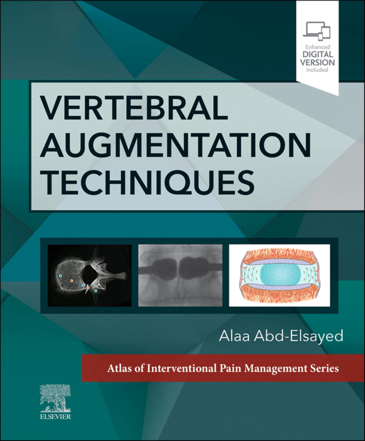 Vertebral Augmentation Techniques - E-Book (Atlas of Interventional Pain Management)