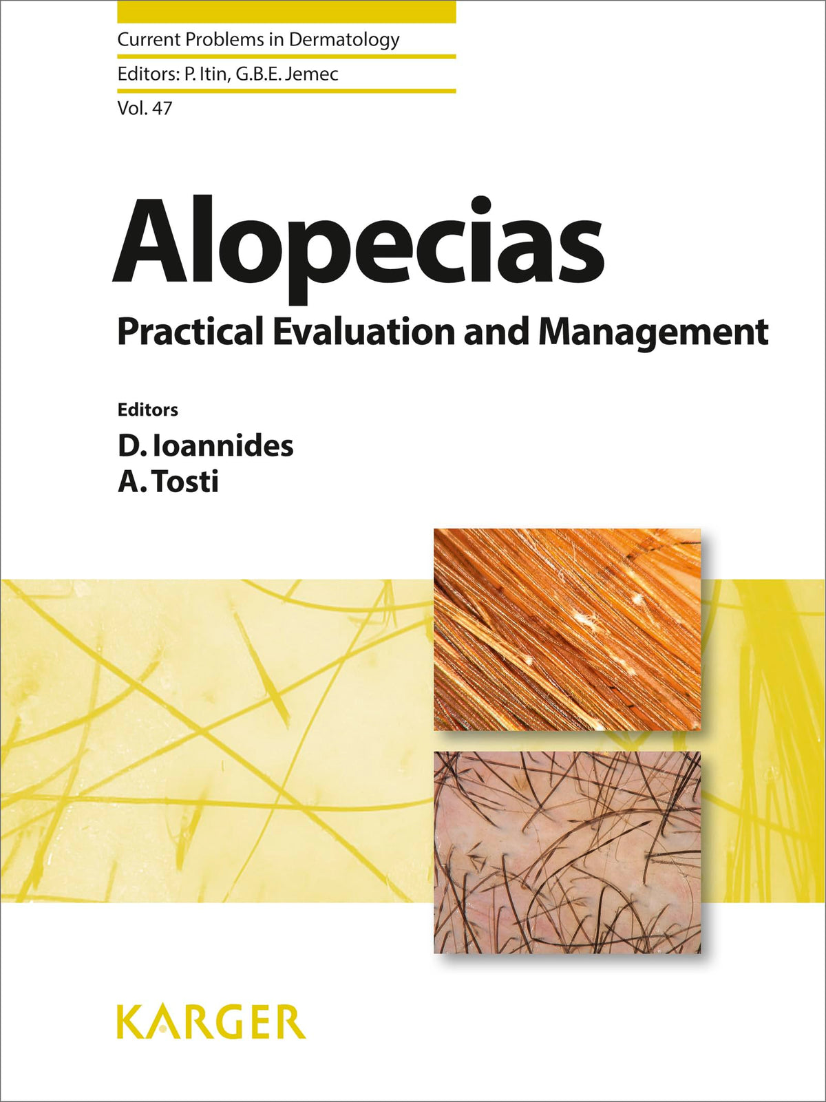 Alopecias - Practical Evaluation and Management (Current Problems in Dermatology Book 47): 1st Edition