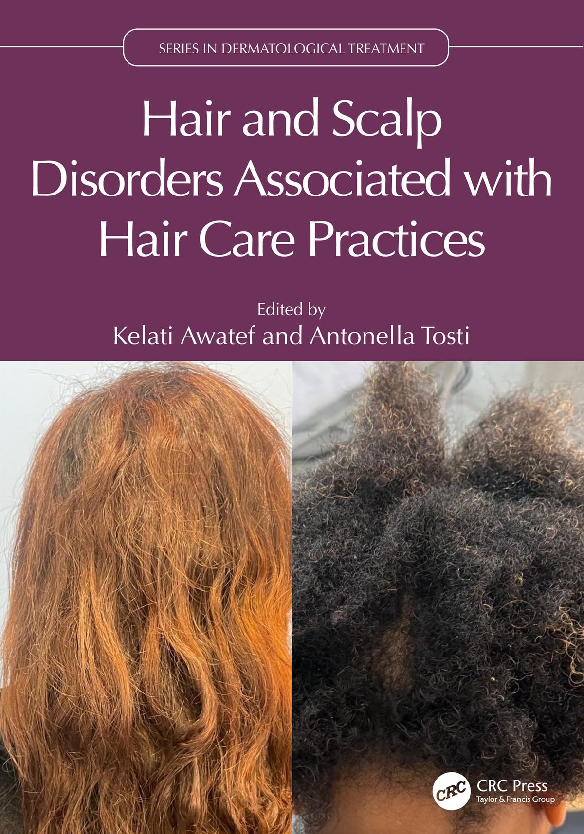 Hair and Scalp Disorders Associated with Hair Care Practices (Series in Dermatological Treatment): 1st Edition