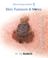 Skin Tumours & Moles: A Diagnostic Atlas (Minor Surgery Series)