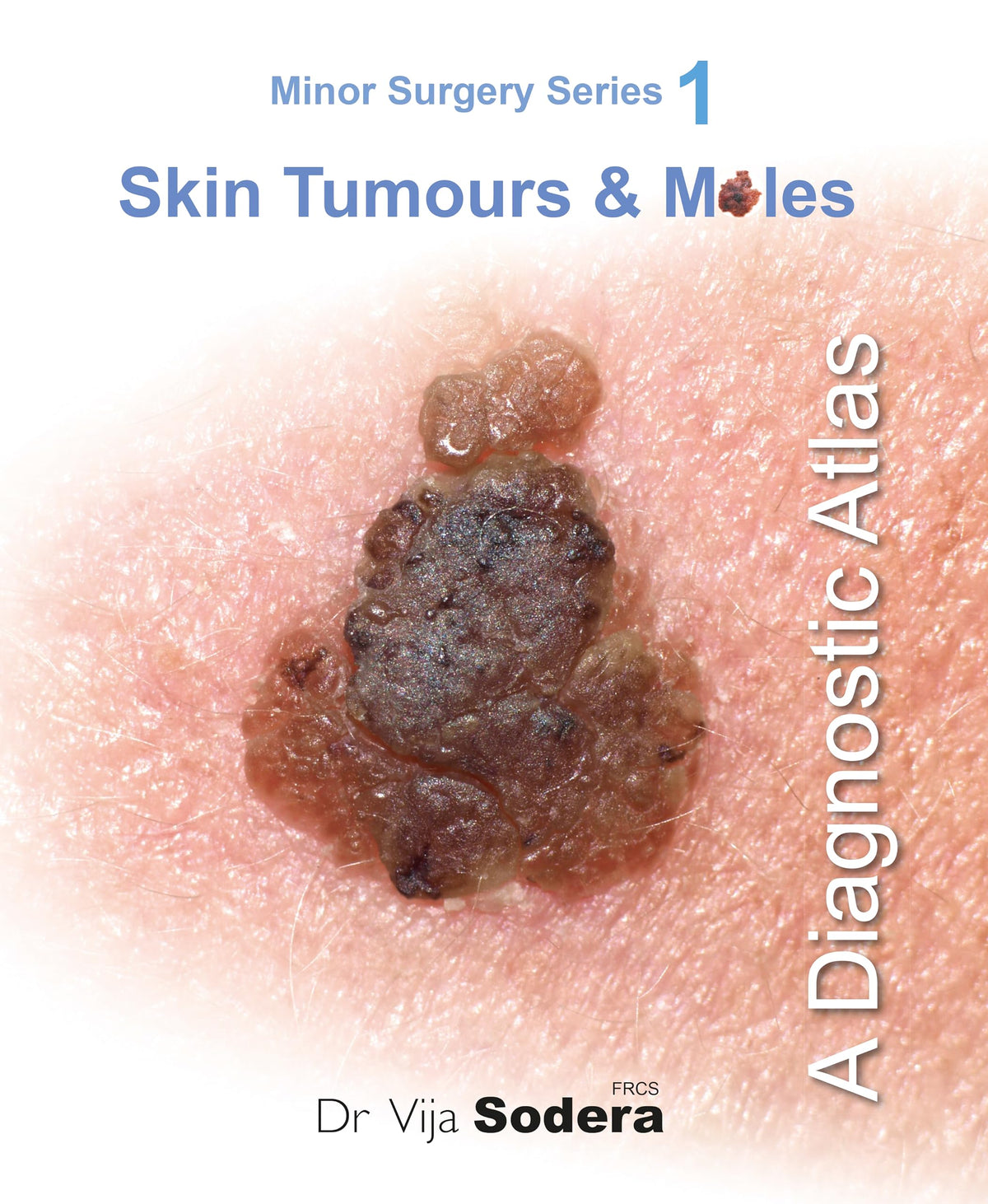 Skin Tumours & Moles: A Diagnostic Atlas (Minor Surgery Series)
