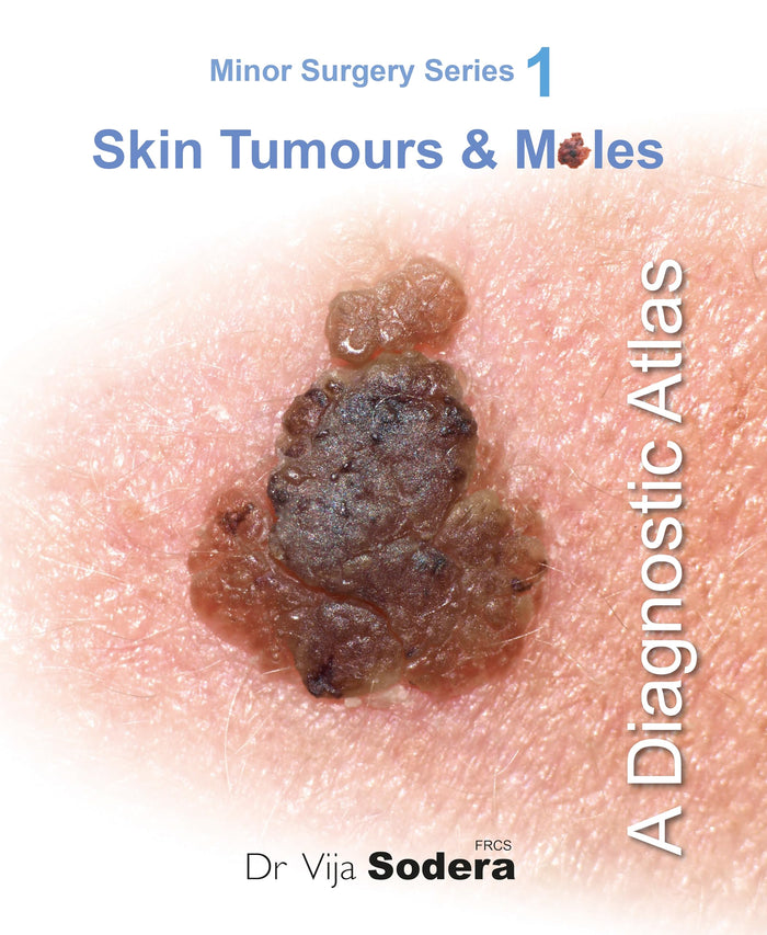 Skin Tumours & Moles: A Diagnostic Atlas (Minor Surgery Series)