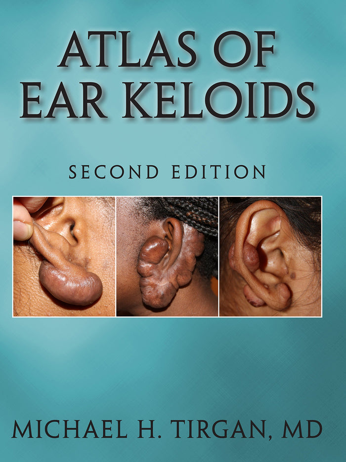 Atlas of Ear Keloids - Second Edition: Kindle Edition